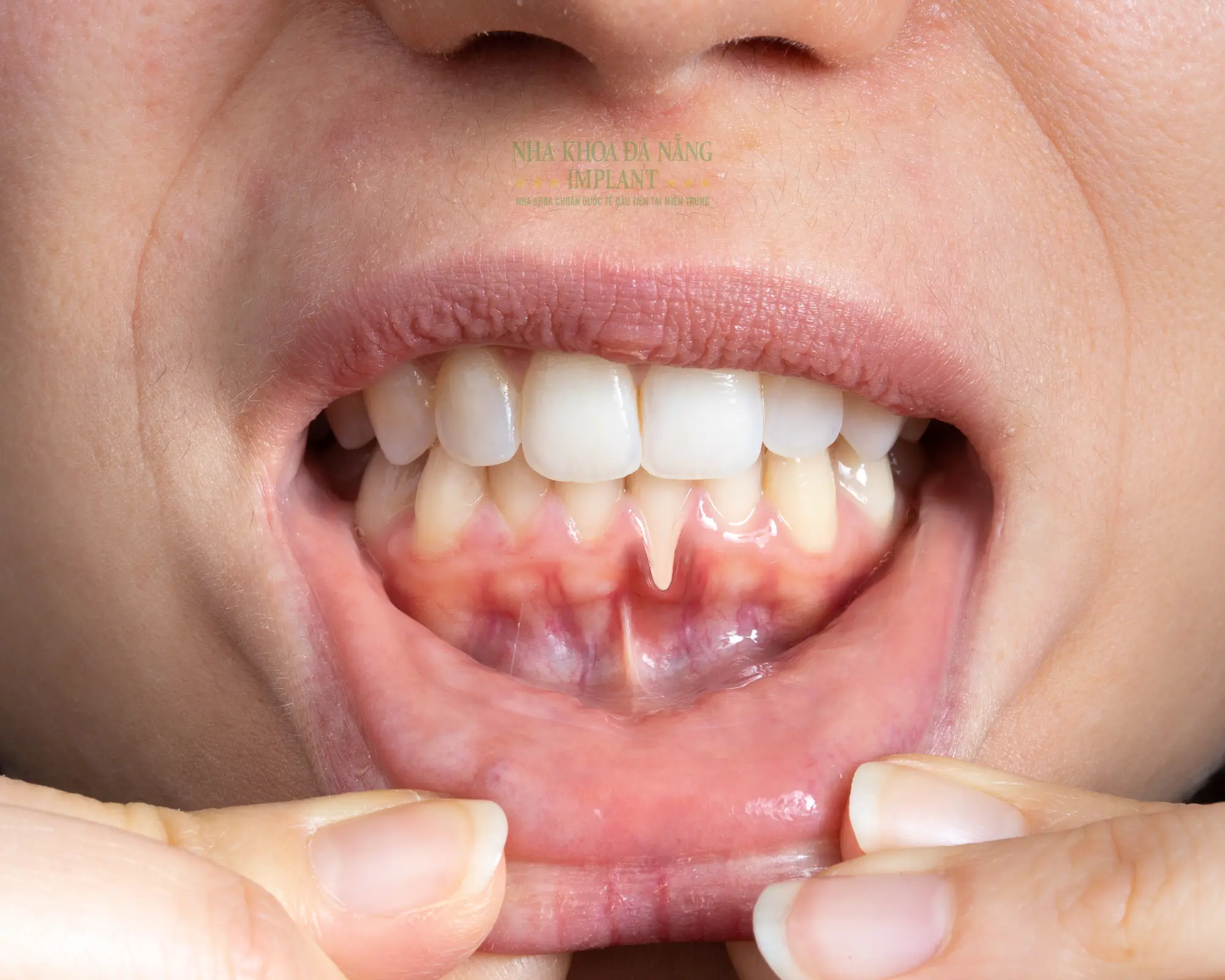 Niềng Răng Hỏng và Dấu Hiệu Nhận Biết và Giải Pháp Từ Nha Khoa Đà Nẵng Implant