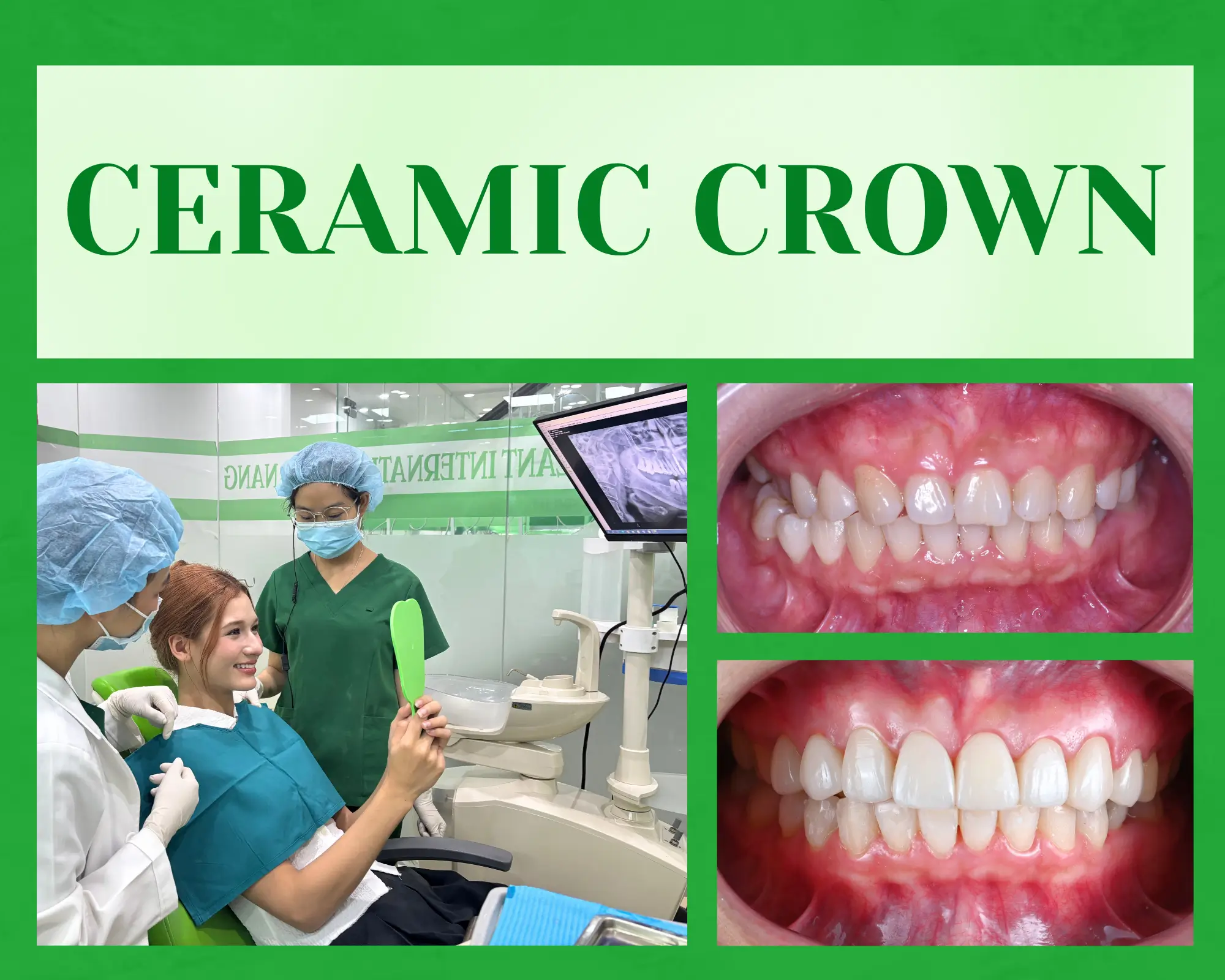 Why is it necessary to completely treat oral diseases before getting dental crowns?