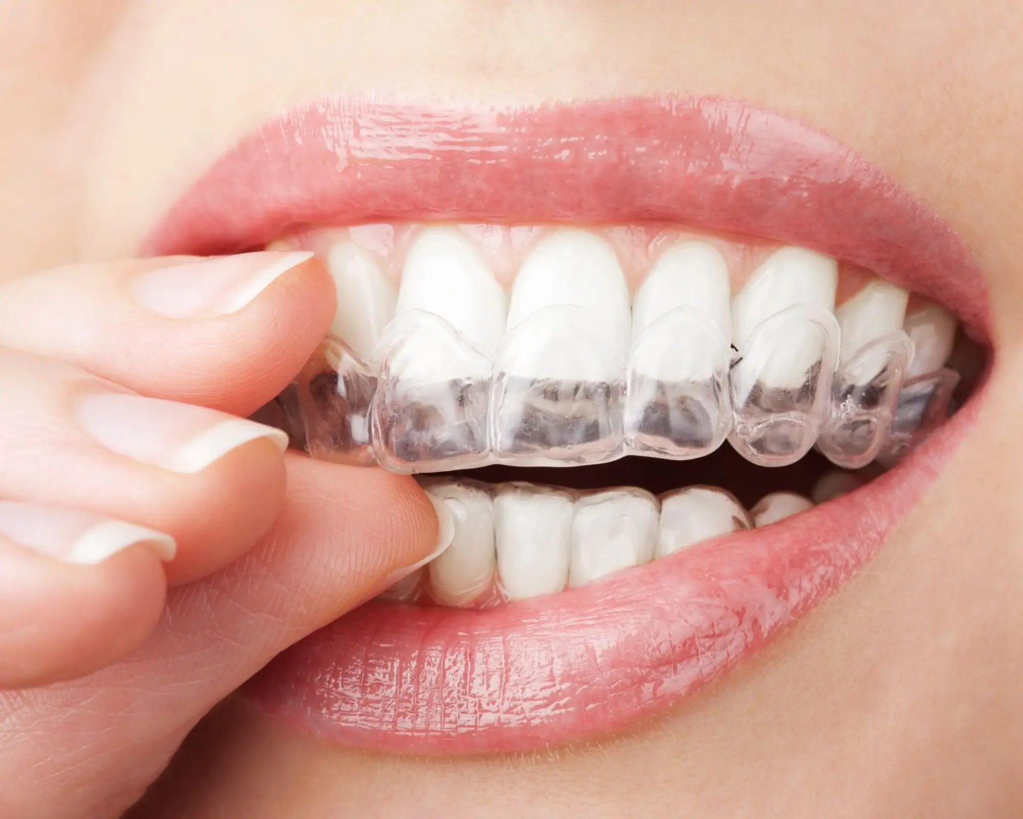 Cách chăm sóc răng sau khi niềng răng để không bị chạy lại – Hướng dẫn chi tiết từ Nha Khoa Đà Nẵng Implant