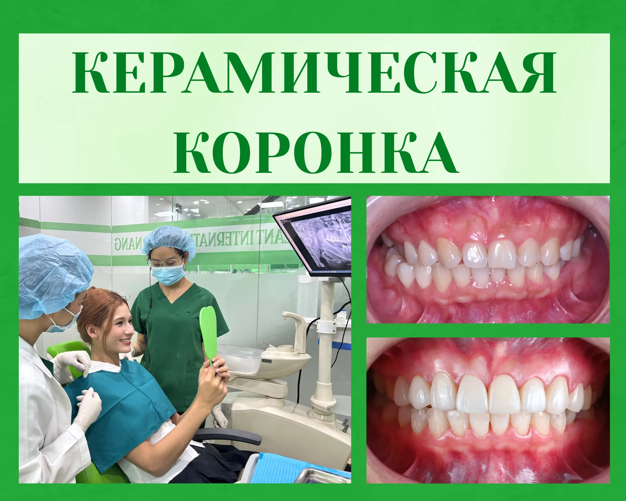 Почему необходимо полностью вылечить заболевания полости рта перед установкой зубных коронок?