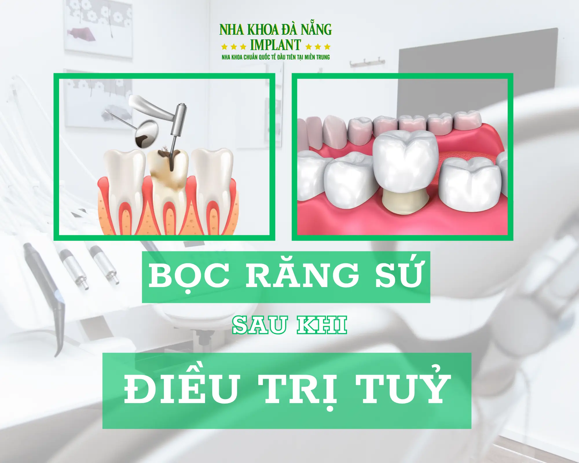 Bọc răng sứ sau khi điều trị tuỷ