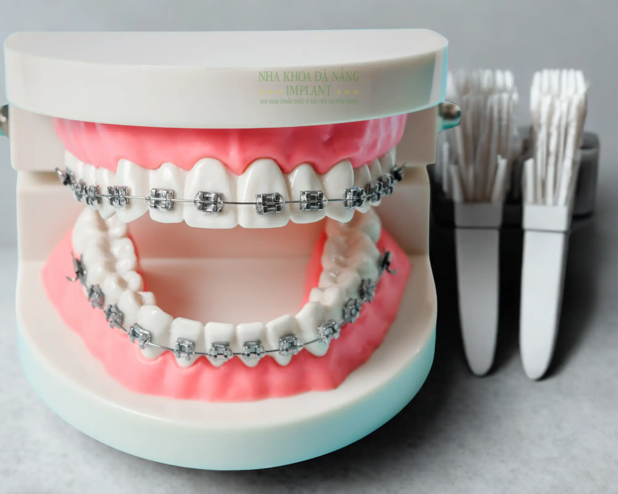 Уход за зубами после брекетов чтобы не сместились – советы от Da Nang Implant Dental Clinic