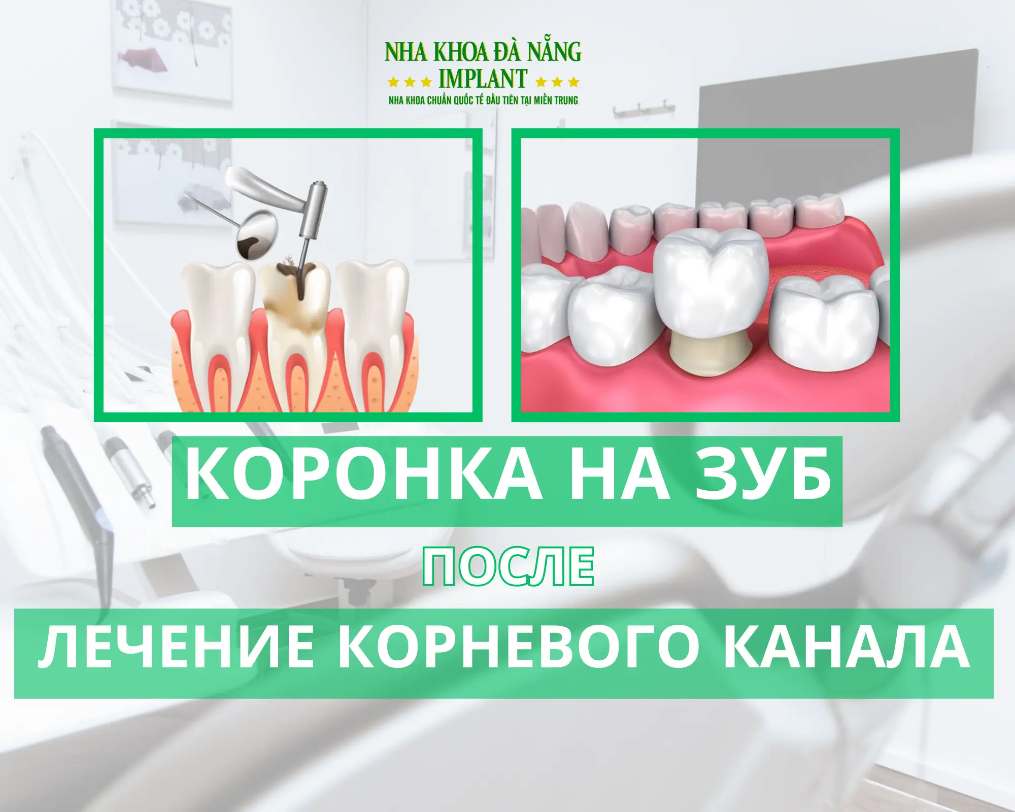 Установка керамической коронки после лечения корневого канала