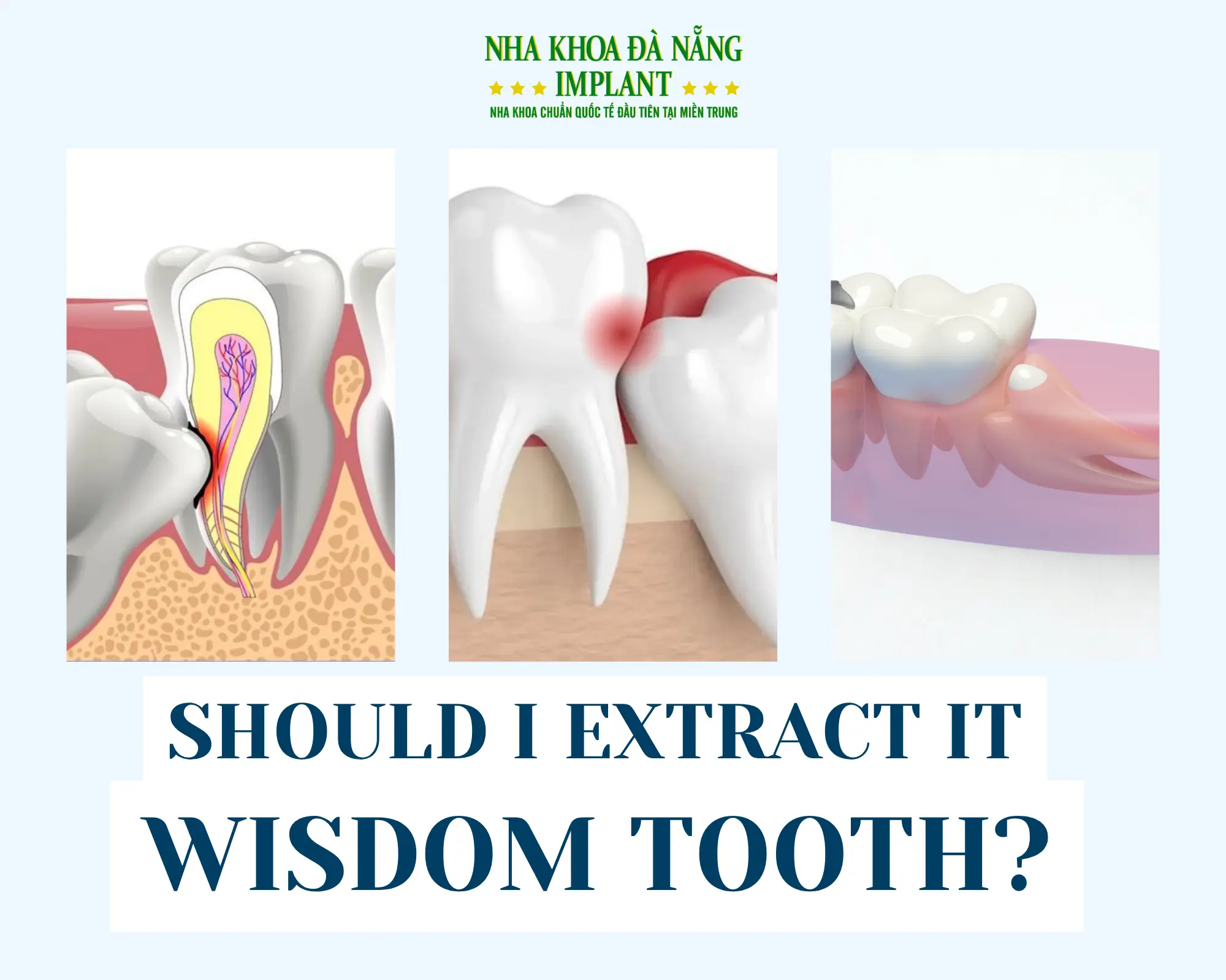 Cases When a Wisdom Tooth Should Be Extracted?
