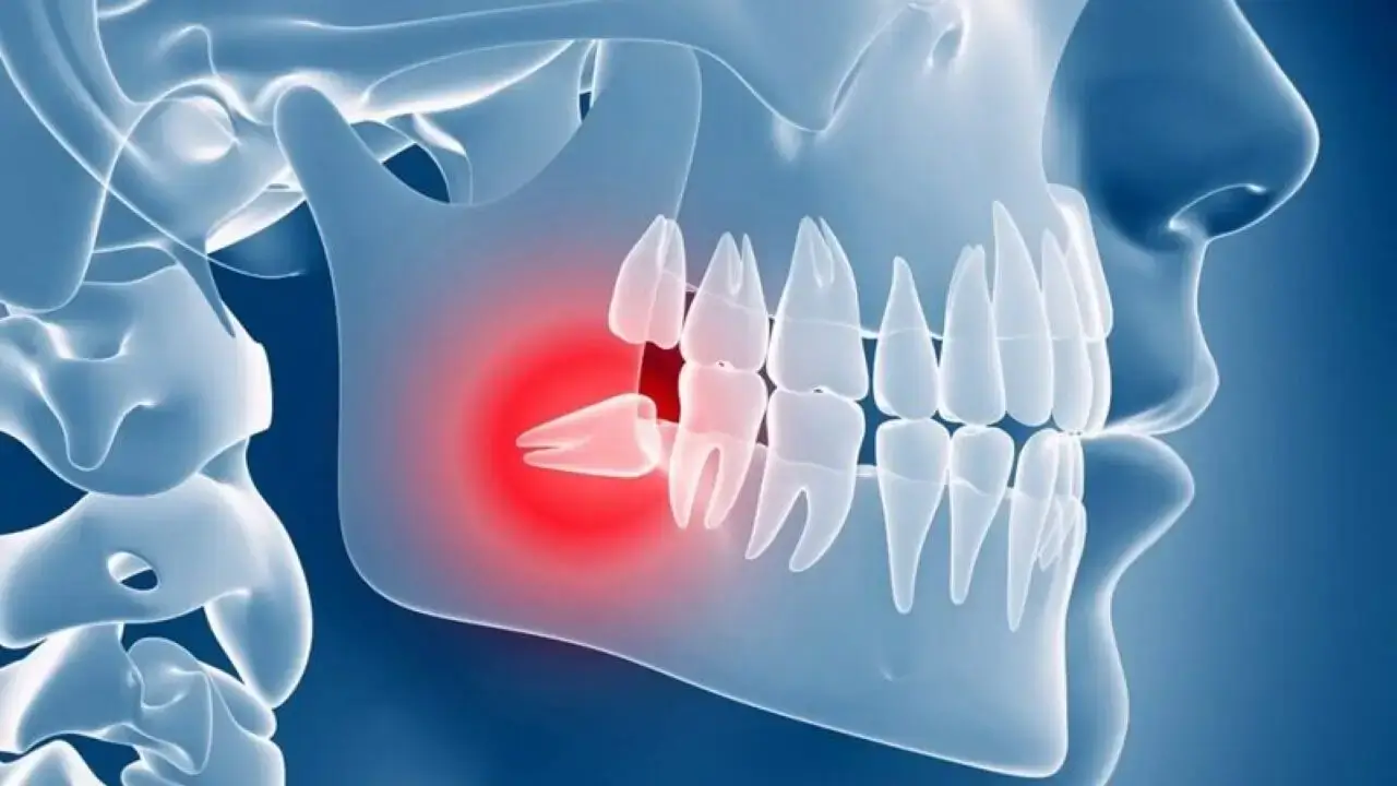 Should wisdom teeth be extracted?