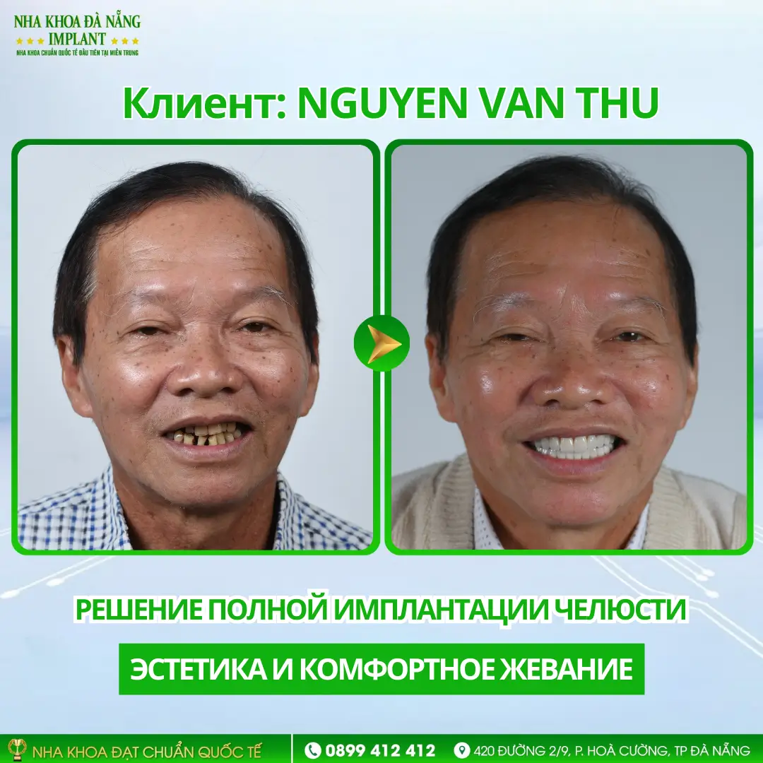 Внутри случая восстановления всей челюсти с помощью имплантов: Процедура – Сроки – Результаты 12 Клиент Nguyen Van Thu | All-on-6 нижняя челюсть – импланты Nobel Active (США)