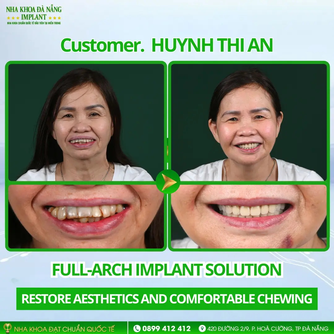Inside a full-arch Implant restoration case: Procedure – Timeline – Results 11 Customer Huynh Thi An | Full-arch Implant – Hiossen Implants (USA)