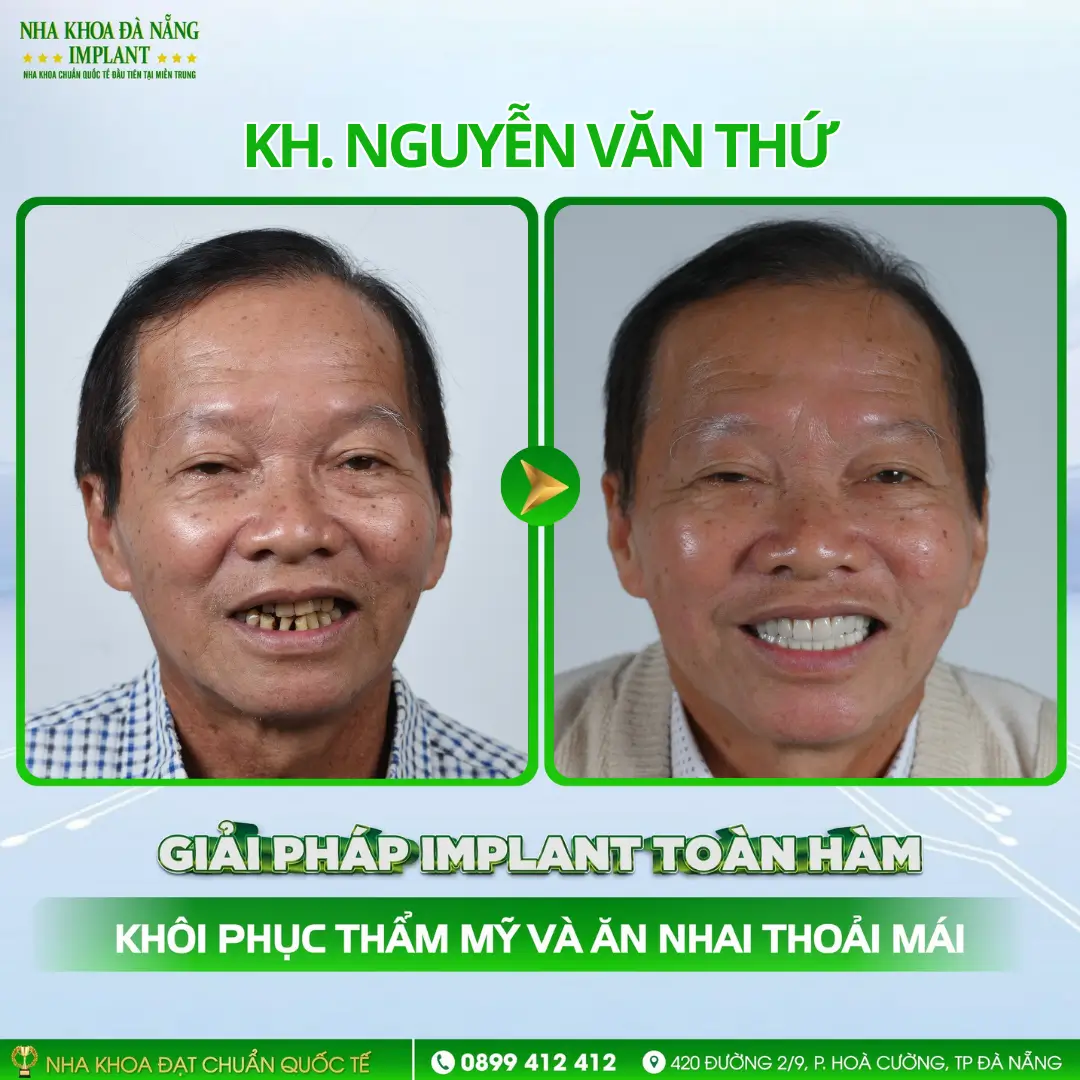 Chú Nguyễn Văn Thứ | All-on-6 hàm dưới trụ Nobel Active (USA)