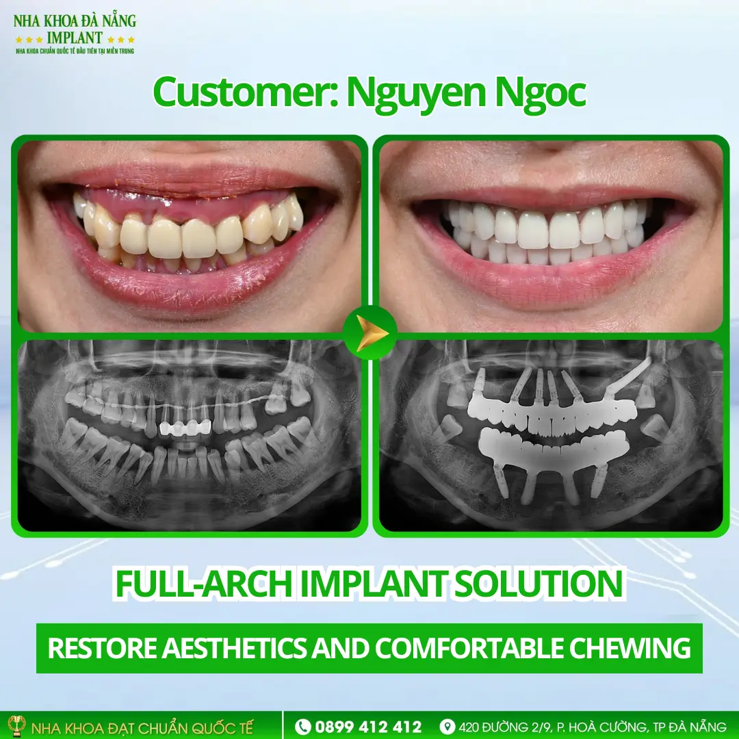 Inside a full-arch Implant restoration case: Procedure – Timeline – Results 13 Customer Nguyen Ngoc | Full-arch Implant – Nobel Parallel Implants (USA)