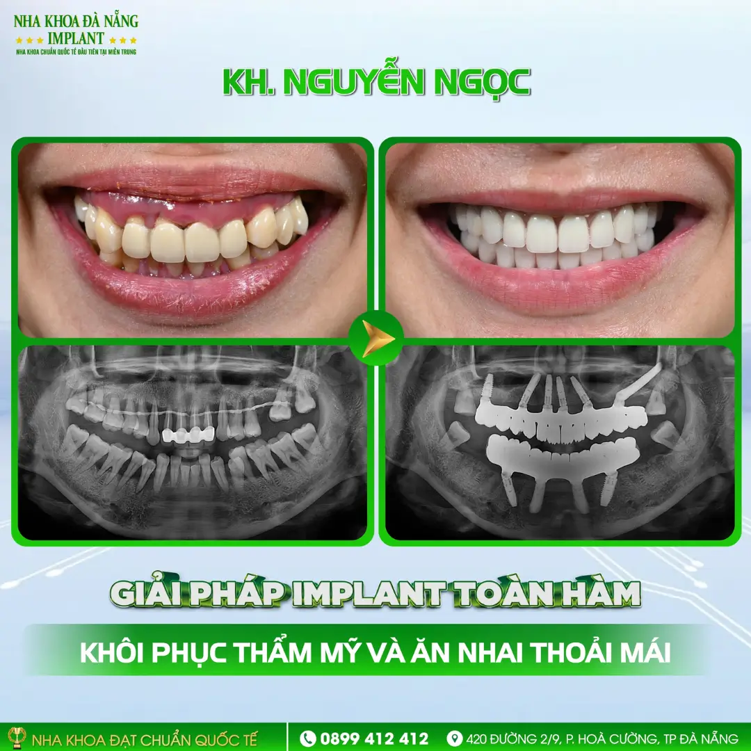 Khách hàng Nguyễn Ngọc | Implant toàn hàm trụ Nobel Parallel (USA)