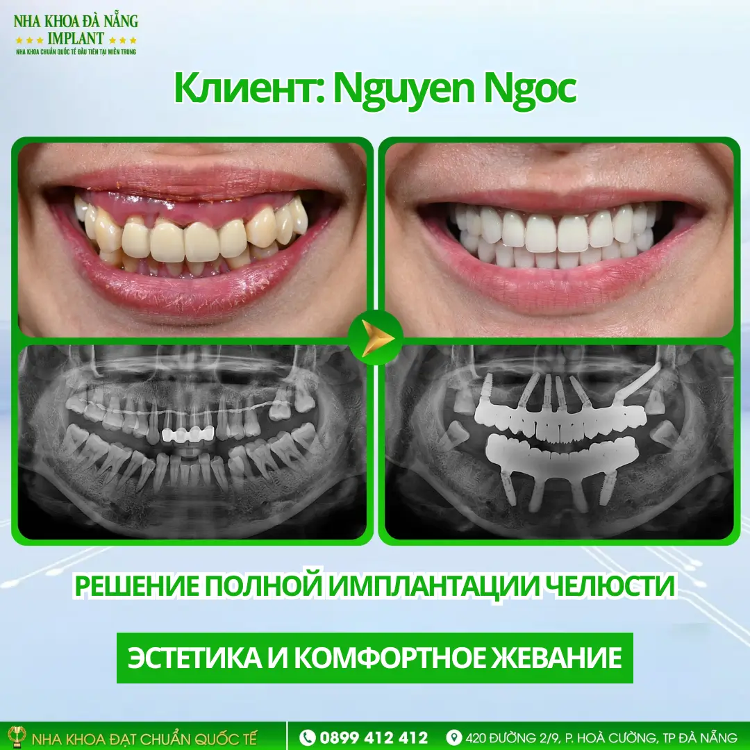Внутри случая восстановления всей челюсти с помощью имплантов: Процедура – Сроки – Результаты 13 Клиент Nguyen Ngoc | Полная имплантация – импланты Nobel Parallel (США)