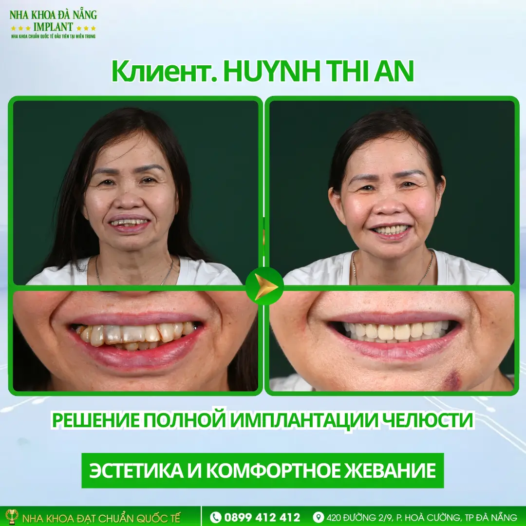Внутри случая восстановления всей челюсти с помощью имплантов: Процедура – Сроки – Результаты 11 Клиент Huynh Thi An | Полная имплантация – Импланты Hiossen (США)