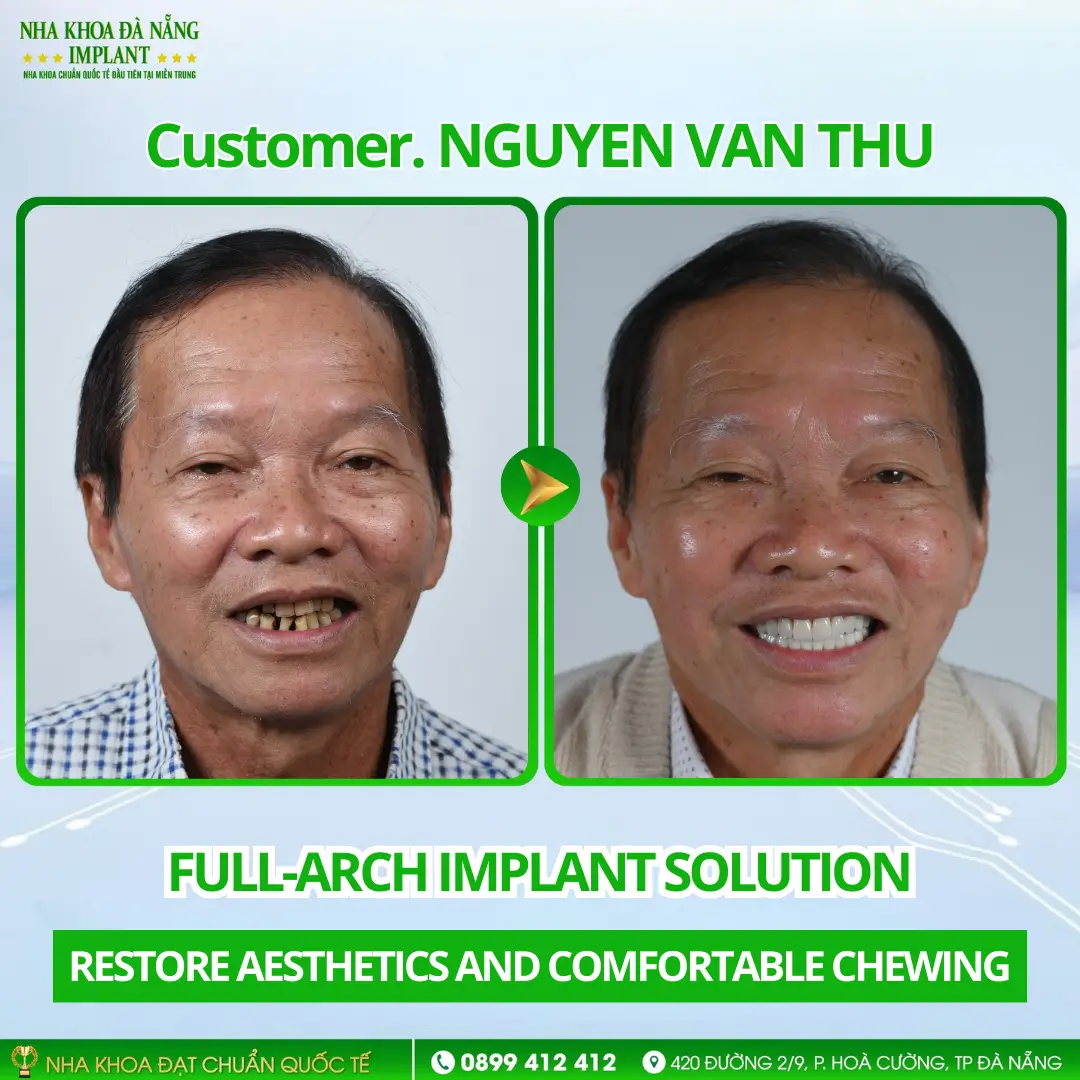 Inside a full-arch Implant restoration case: Procedure – Timeline – Results 12 Customer Nguyen Van Thu | All-on-6 Lower Jaw – Nobel Active Implants (USA)