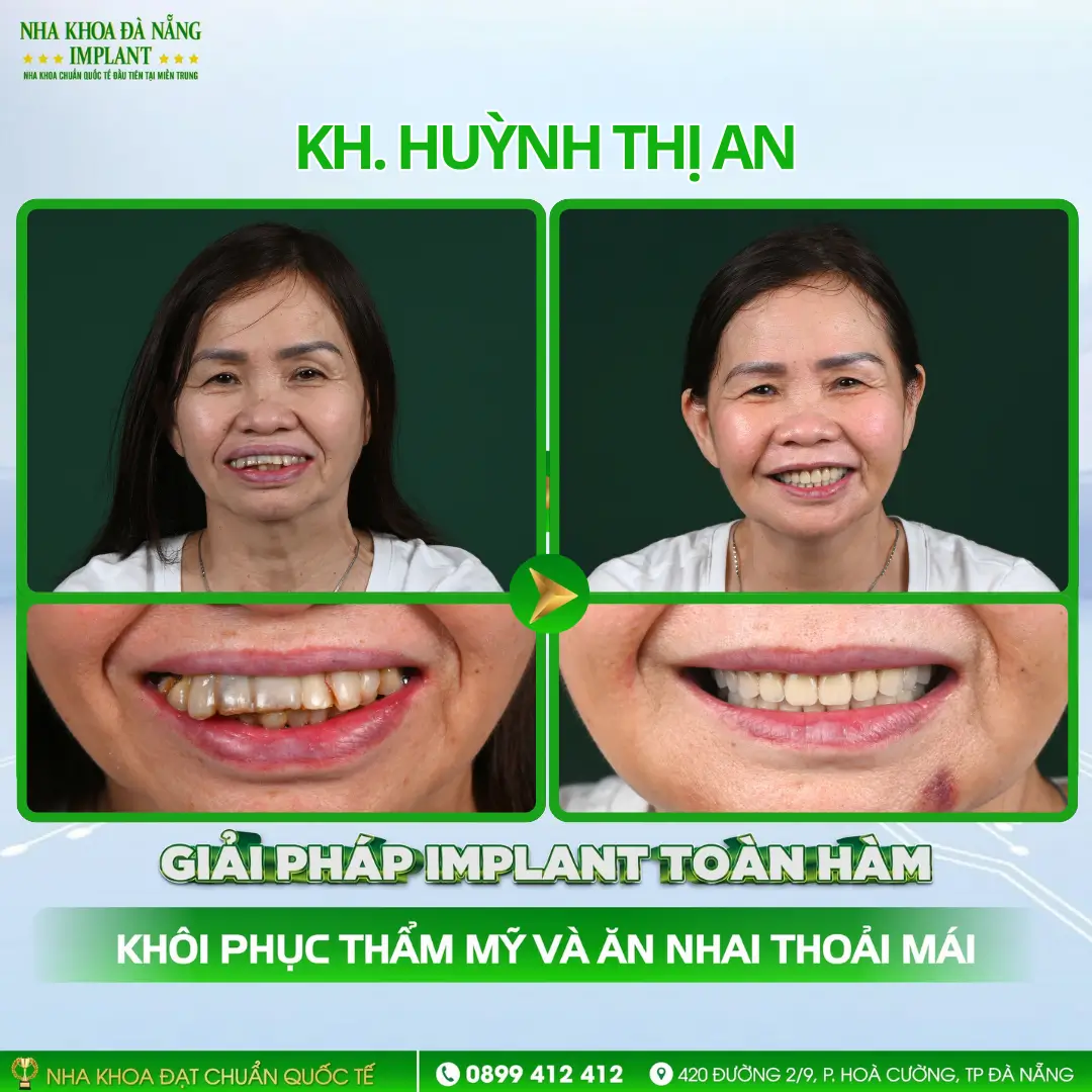 Khách hàng Huỳnh Thị An | Implant toàn hàm – Trụ Hiossen (Mỹ)
