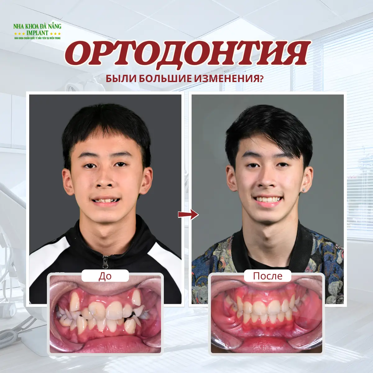 5 Самых Больших Страхов При Ношении Брекетов – Как Врачи Помогают Вам Их Преодолеть 9 Изменения после ортодонтического лечения