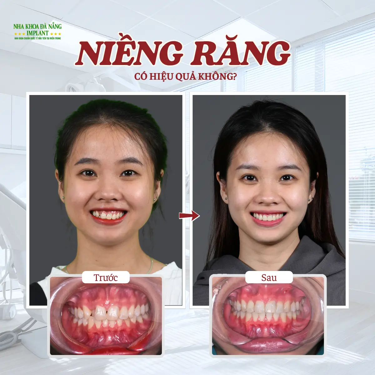 Niềng răng có xấu không, có hiệu quả không?