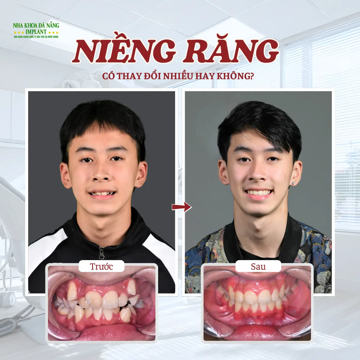 Sự thay đổi nhờ niềng răng