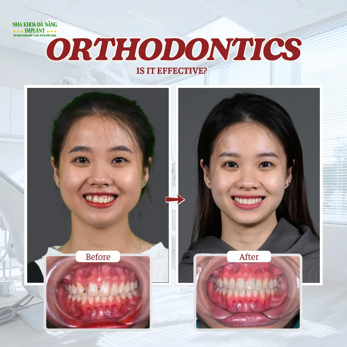 5 Biggest Fears When Getting Braces – How Dentists Help You Overcome Them 7 Are braces ugly, are they effective?