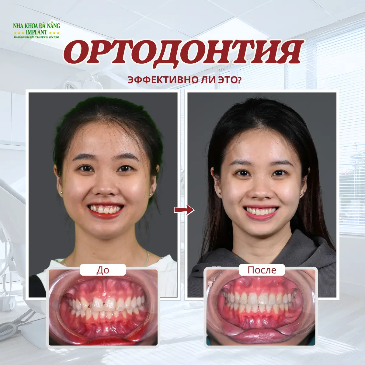 5 Самых Больших Страхов При Ношении Брекетов – Как Врачи Помогают Вам Их Преодолеть 7 Брекеты выглядят некрасиво, они эффективны?