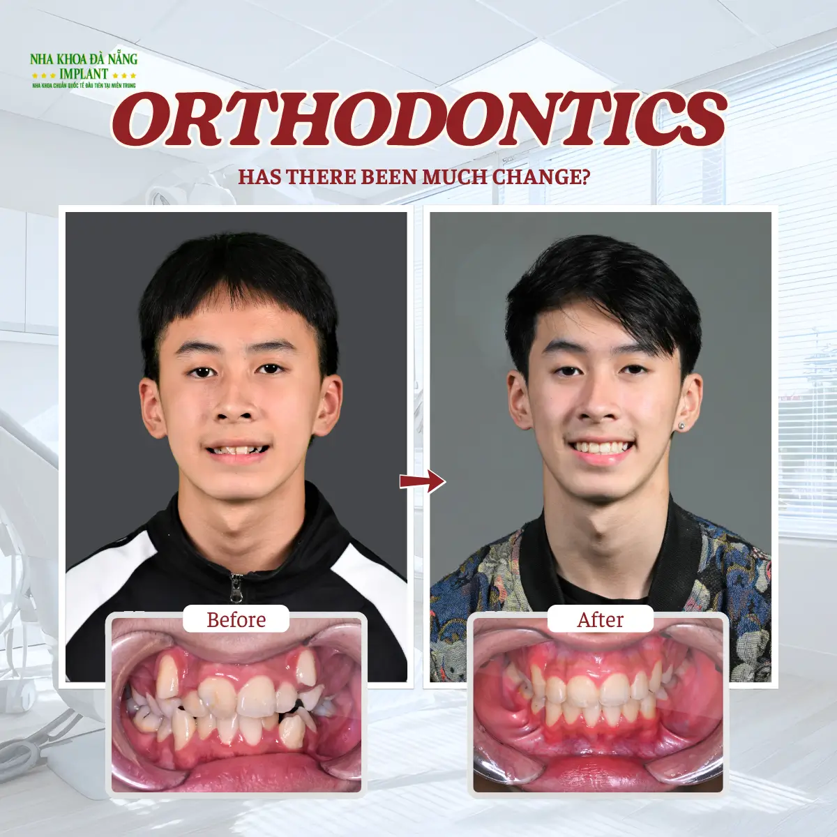 5 Biggest Fears When Getting Braces – How Dentists Help You Overcome Them 9 Changes from Orthodontic Treatment