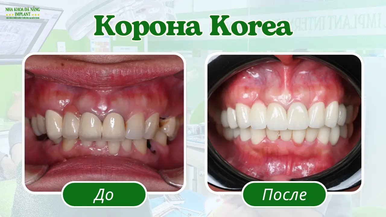 Коронки Korea