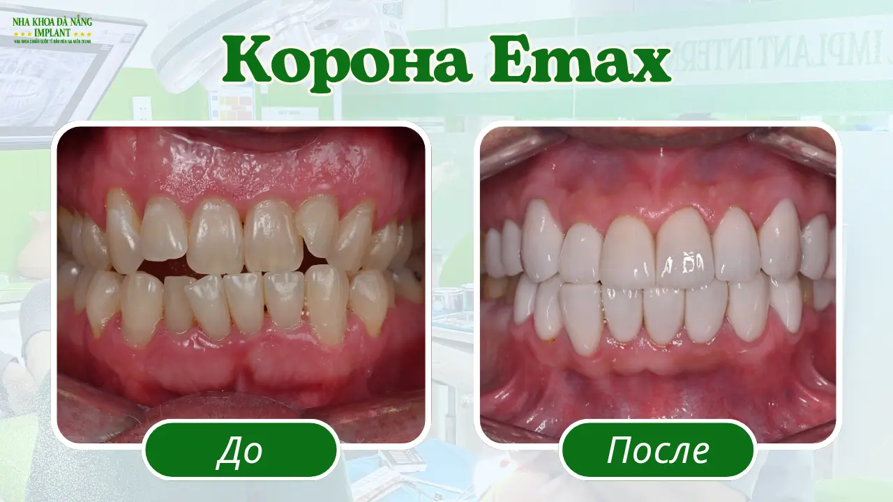 Коронки Emax