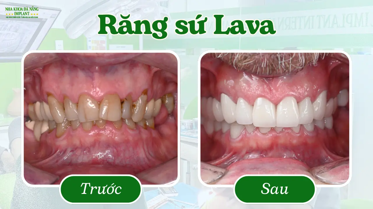 Răng sứ Lava – Đỉnh cao công nghệ từ Mỹ
