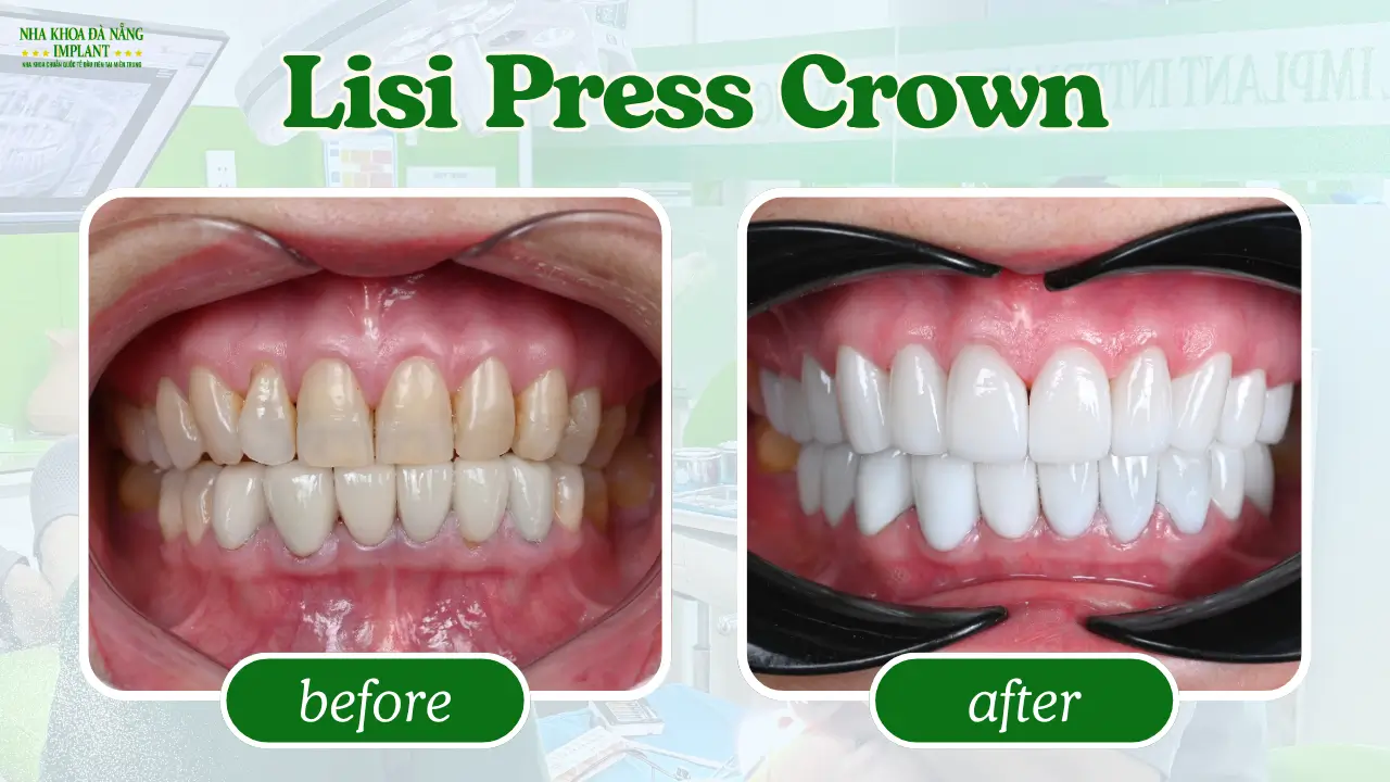 Lisi Press Porcelain