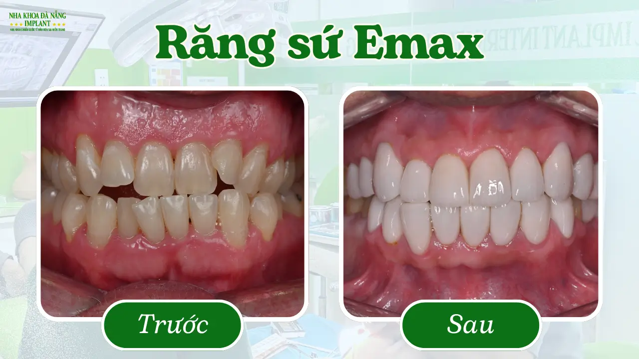Răng sứ Emax – Vẻ đẹp tự nhiên đến từ Đức