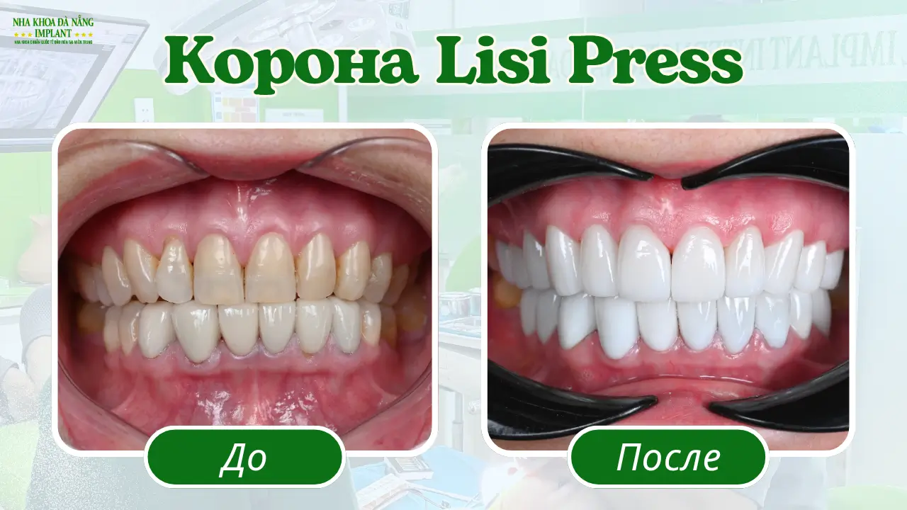 Коронки Lisi Press