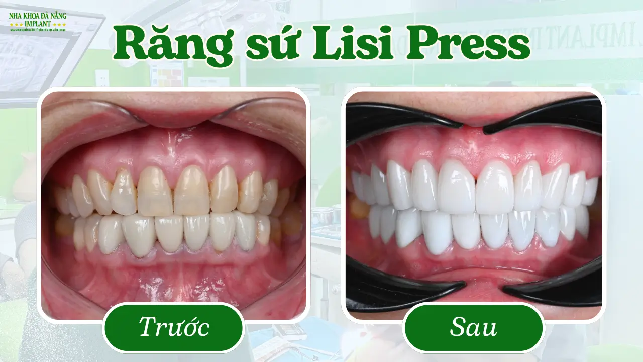 Răng sứ Lisi Press – Dòng sứ thủy tinh cao cấp từ Nhật Bản