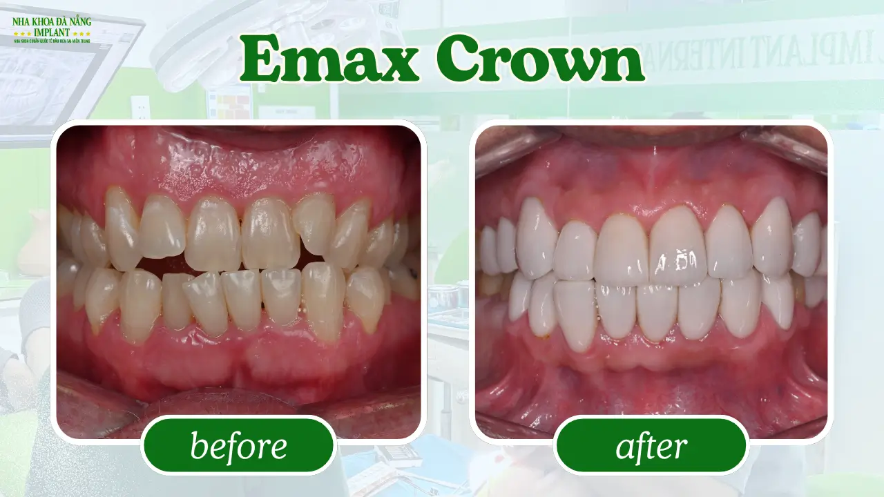 Emax Porcelain Crowns