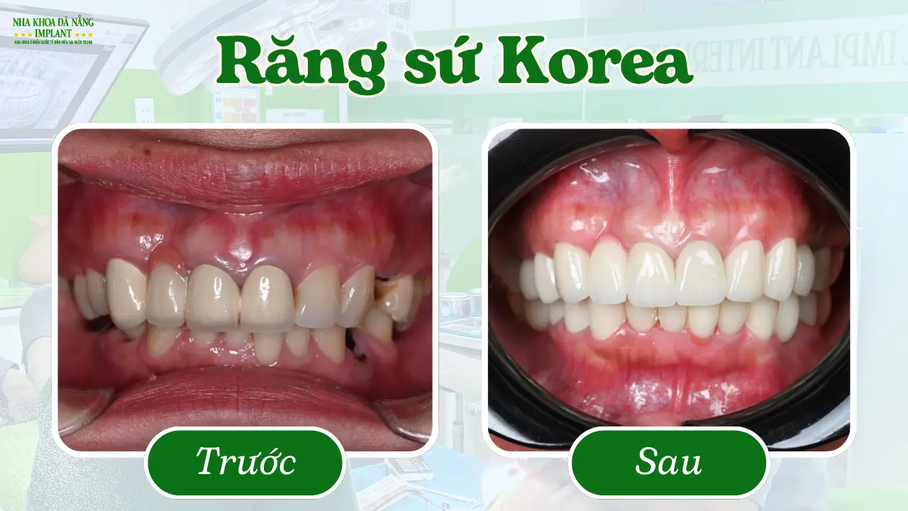 Răng sứ Korea – Lựa chọn thông minh, đẹp bền mà vẫn tiết kiệm