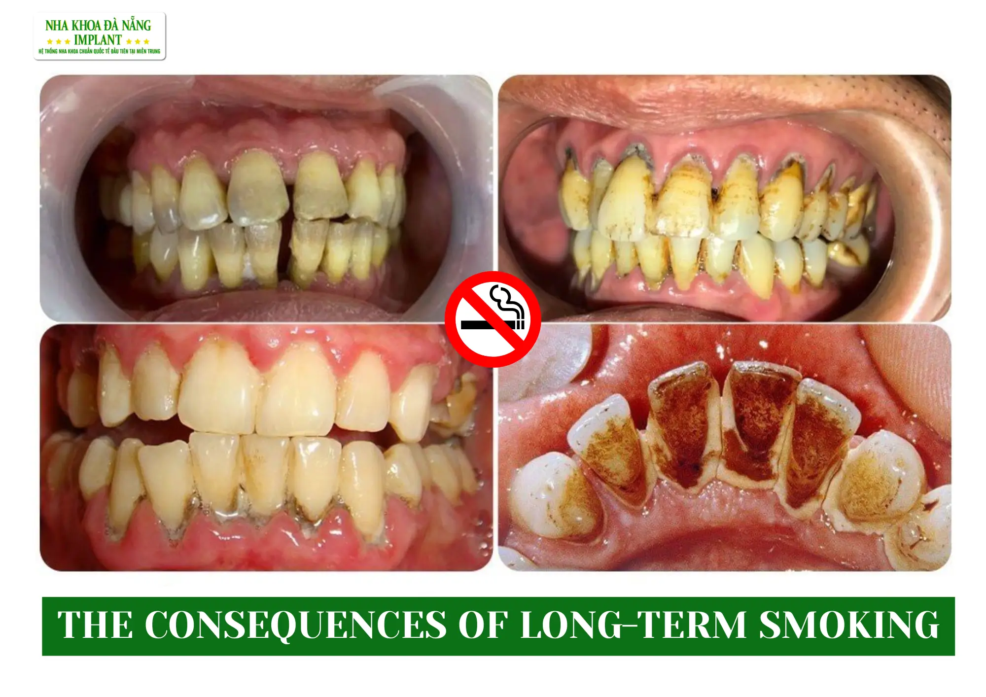 How does smoking affect oral health