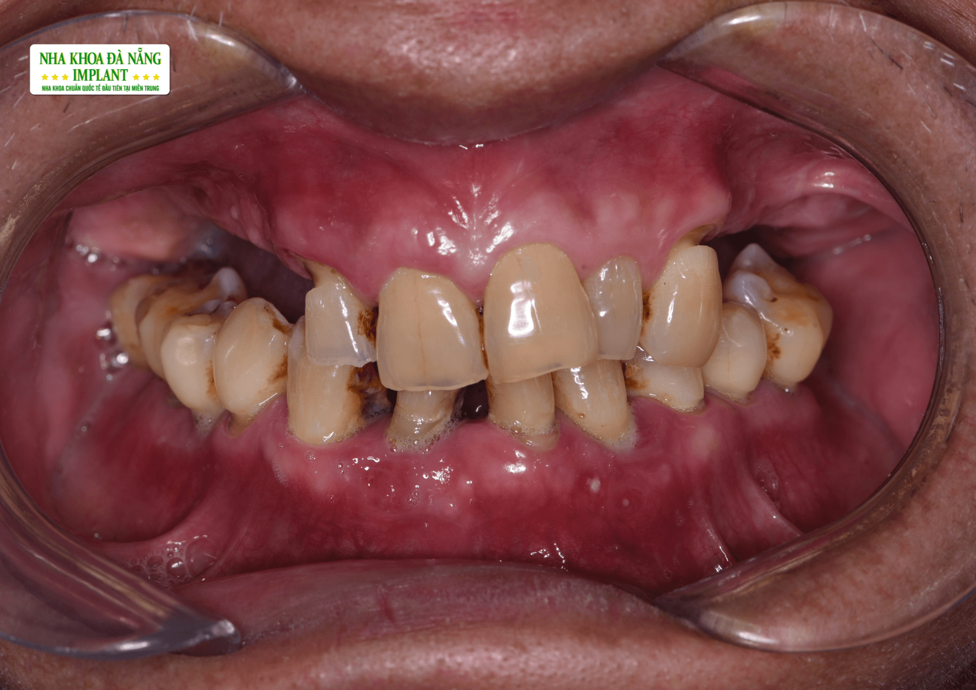 Курение вызывает выпадение зубов, пожелтение и неприятный запах изо рта.