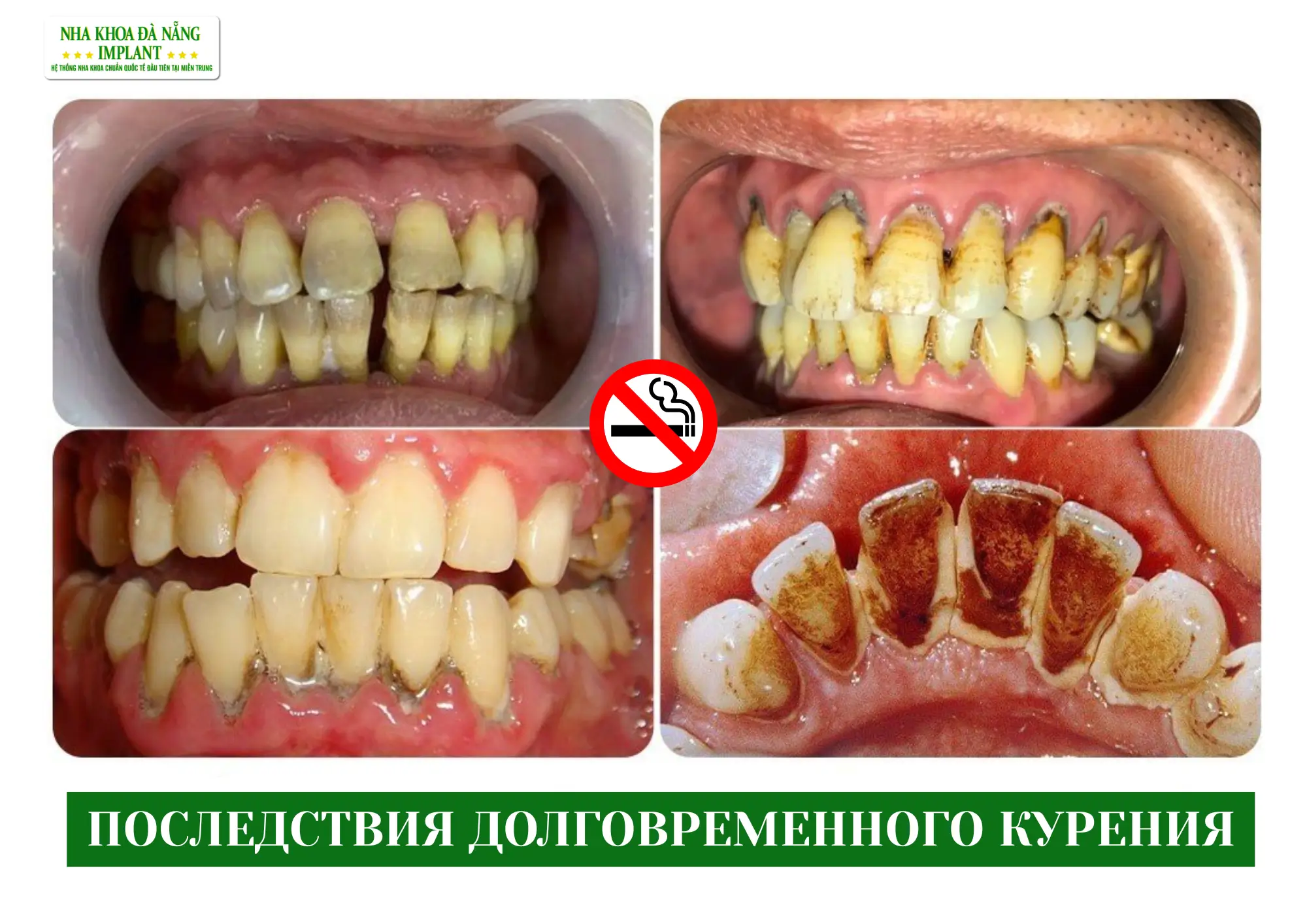 Как курение влияет на здоровье полости рта