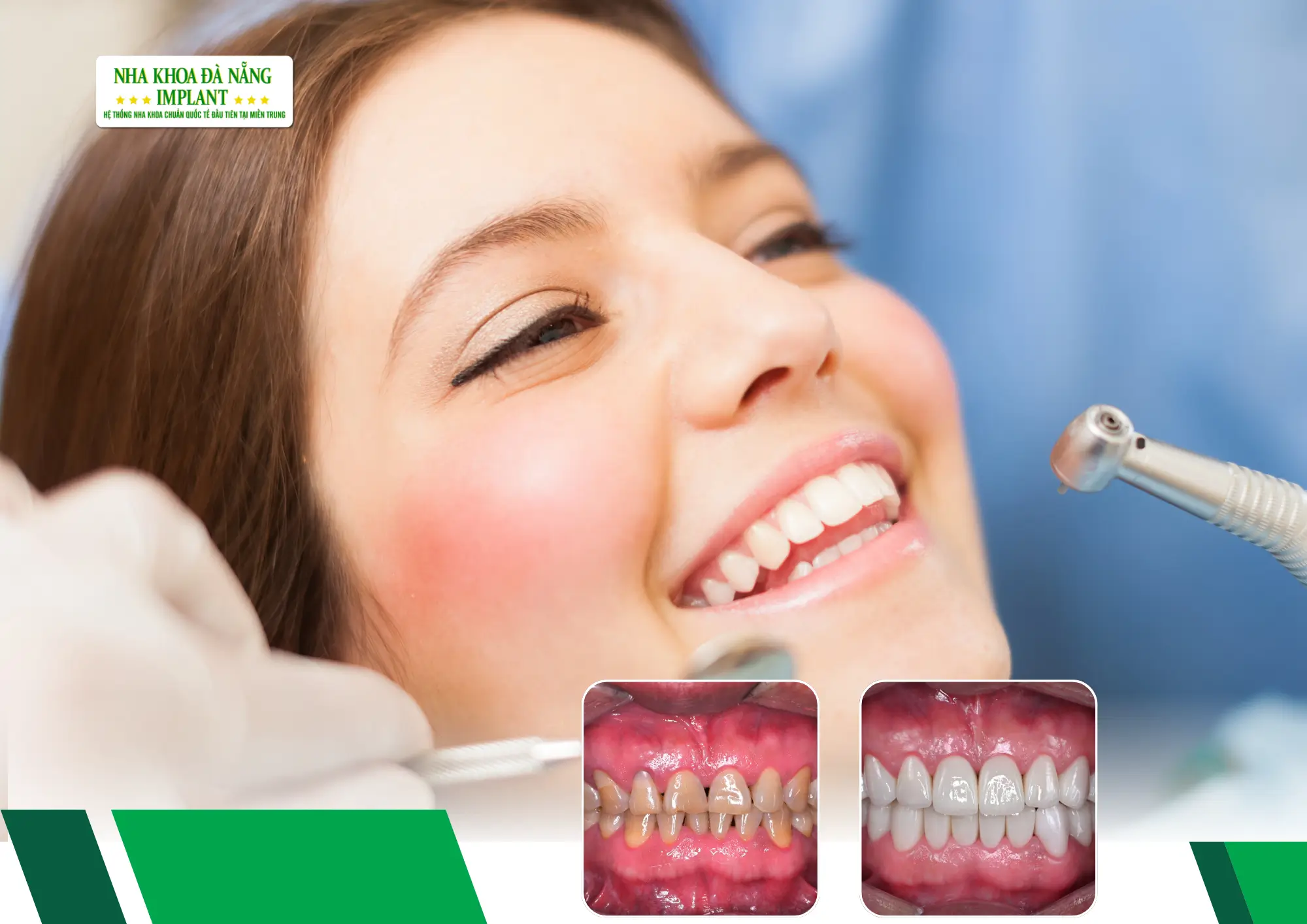 Мелкие привычки которые разрушают керамические зубы и о которых не знают 90% клиентов