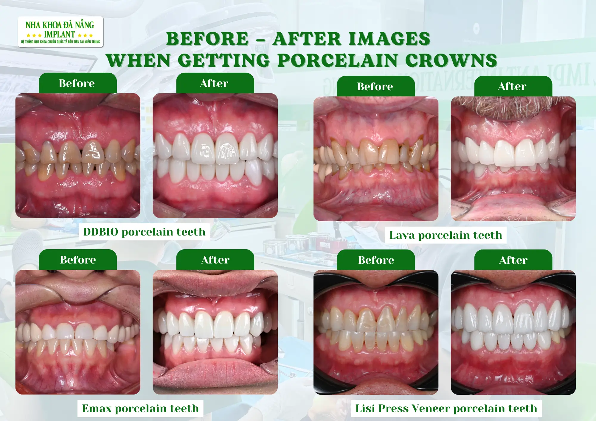 Small habits that can damage porcelain teeth without 90% of customers realizing it 13 High-quality porcelain materials – Natural beauty, durable