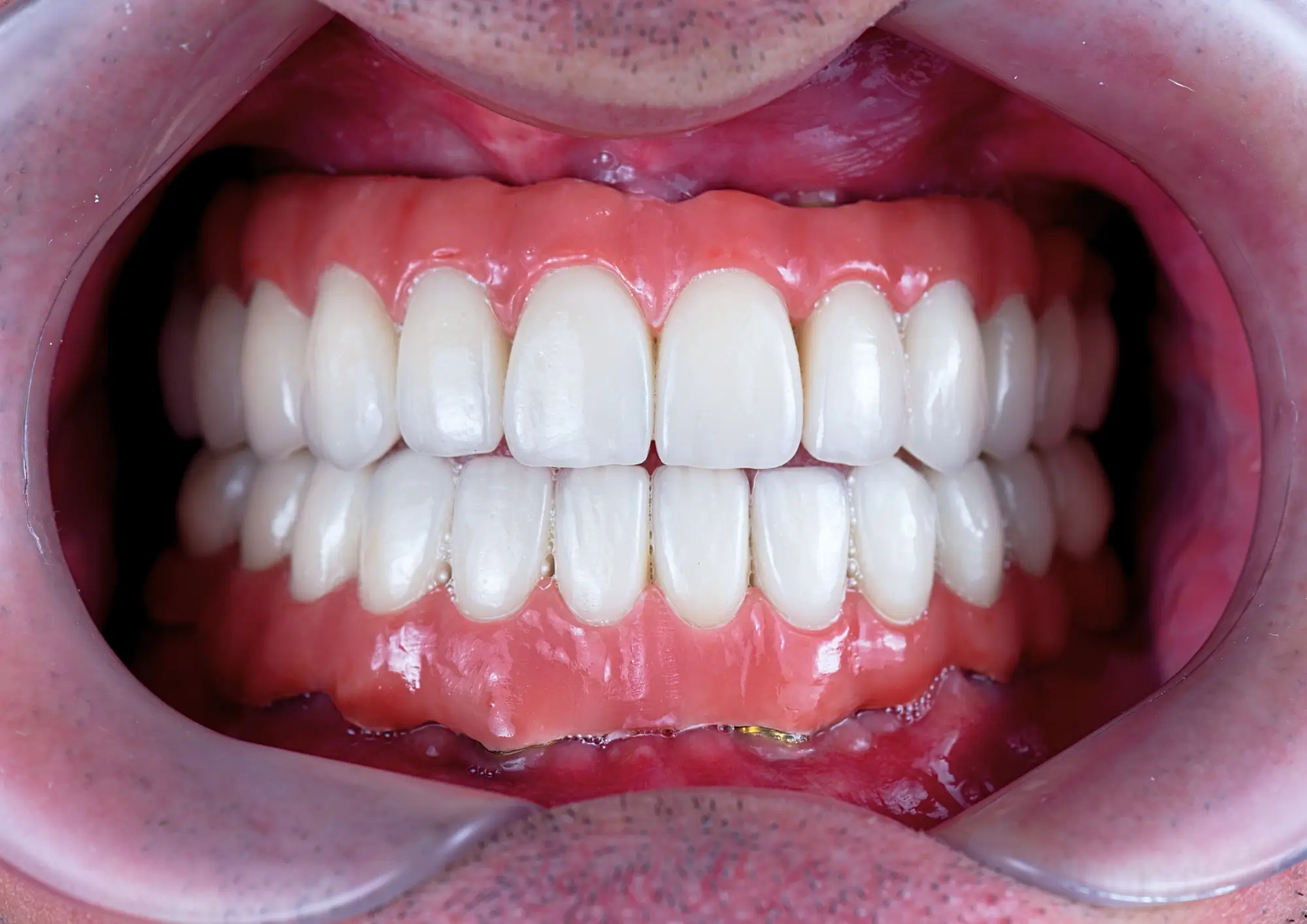 Внутри случая восстановления всей челюсти с помощью имплантов: Процедура – Сроки – Результаты 10 Результаты после полной имплантации челюсти