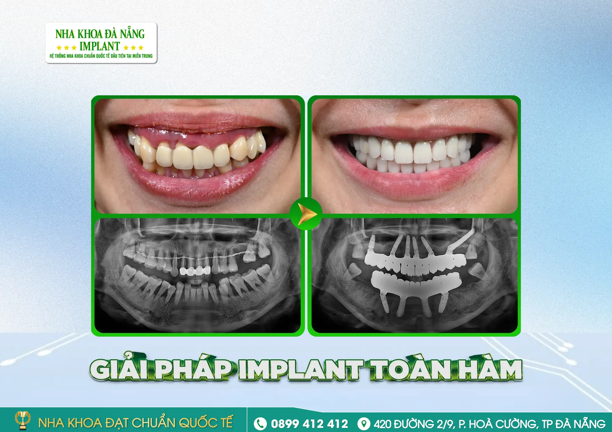Bên trong 1 ca trồng Implant mất gốc toàn hàm: Quy trình – Thời gian – Kết quả