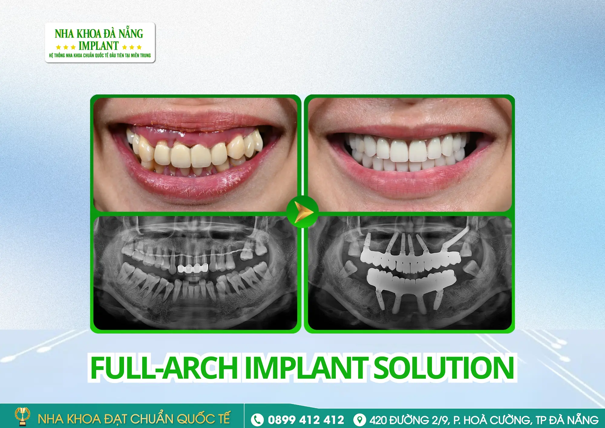 Inside a full-arch Implant restoration case: Procedure – Timeline – Results
