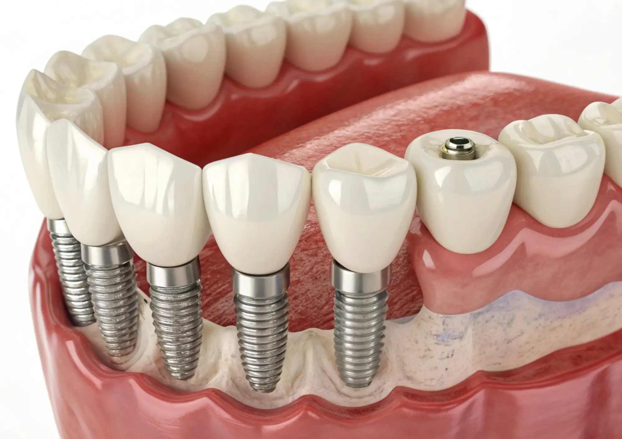 Внутри случая восстановления всей челюсти с помощью имплантов: Процедура – Сроки – Результаты 8 Что такое имплантация всей челюсти?