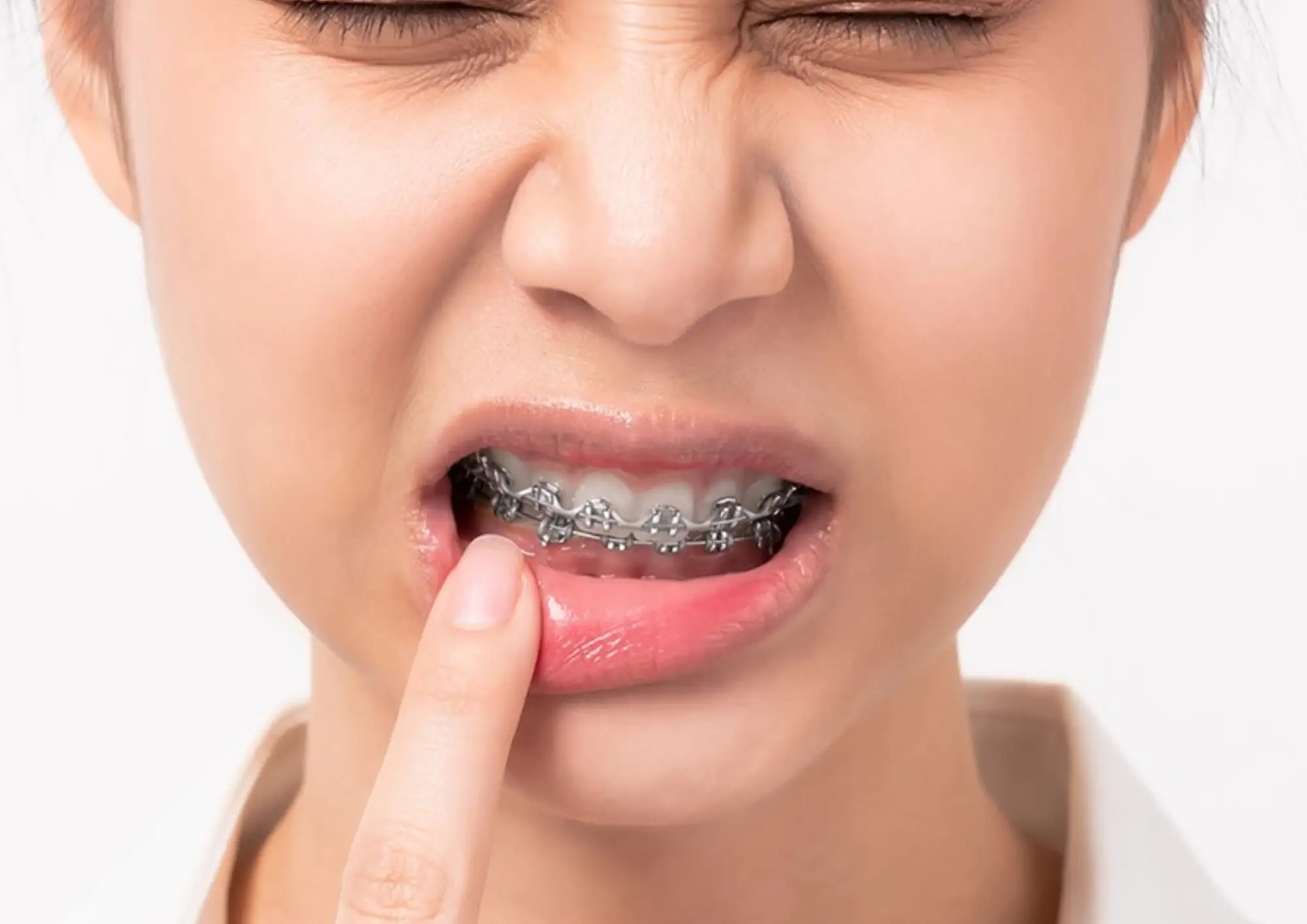 Niềng răng có đau không?