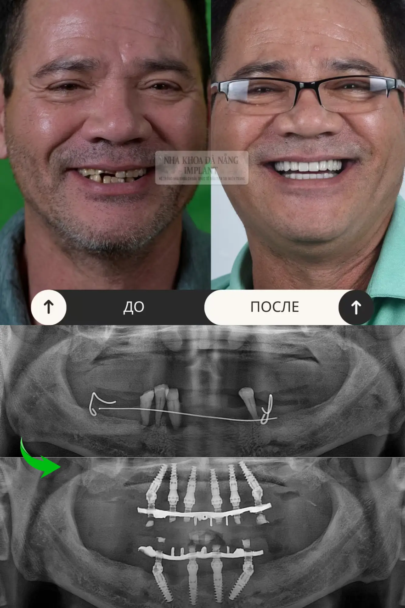 5 Характеристик имплантов Nobel Biocare – Решение для восстановления зубов которое выбирают многие клиенты 18 Пациент Duong Binh