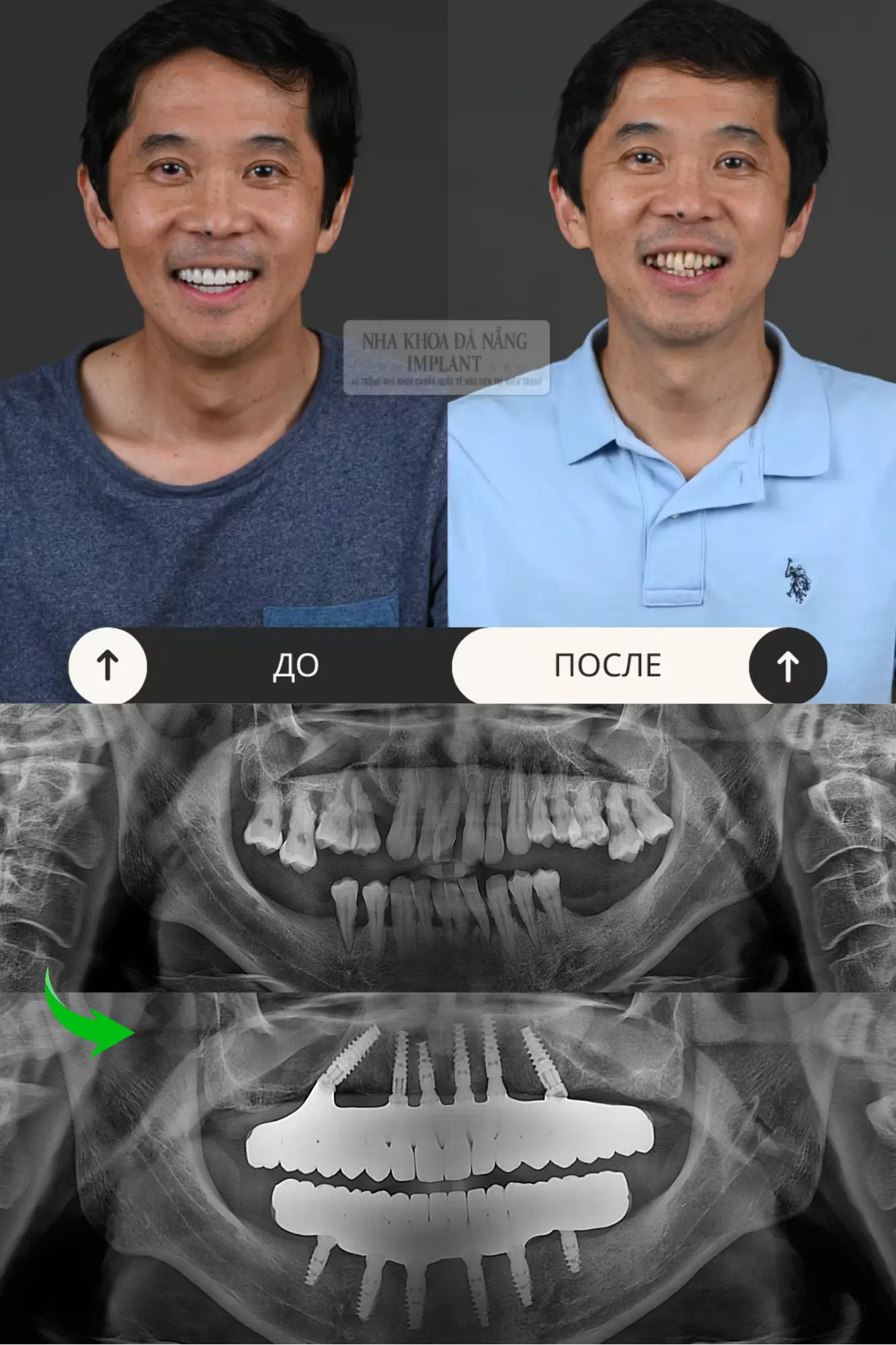 5 Характеристик имплантов Nobel Biocare – Решение для восстановления зубов которое выбирают многие клиенты 20 Пациент Le Hung Viet