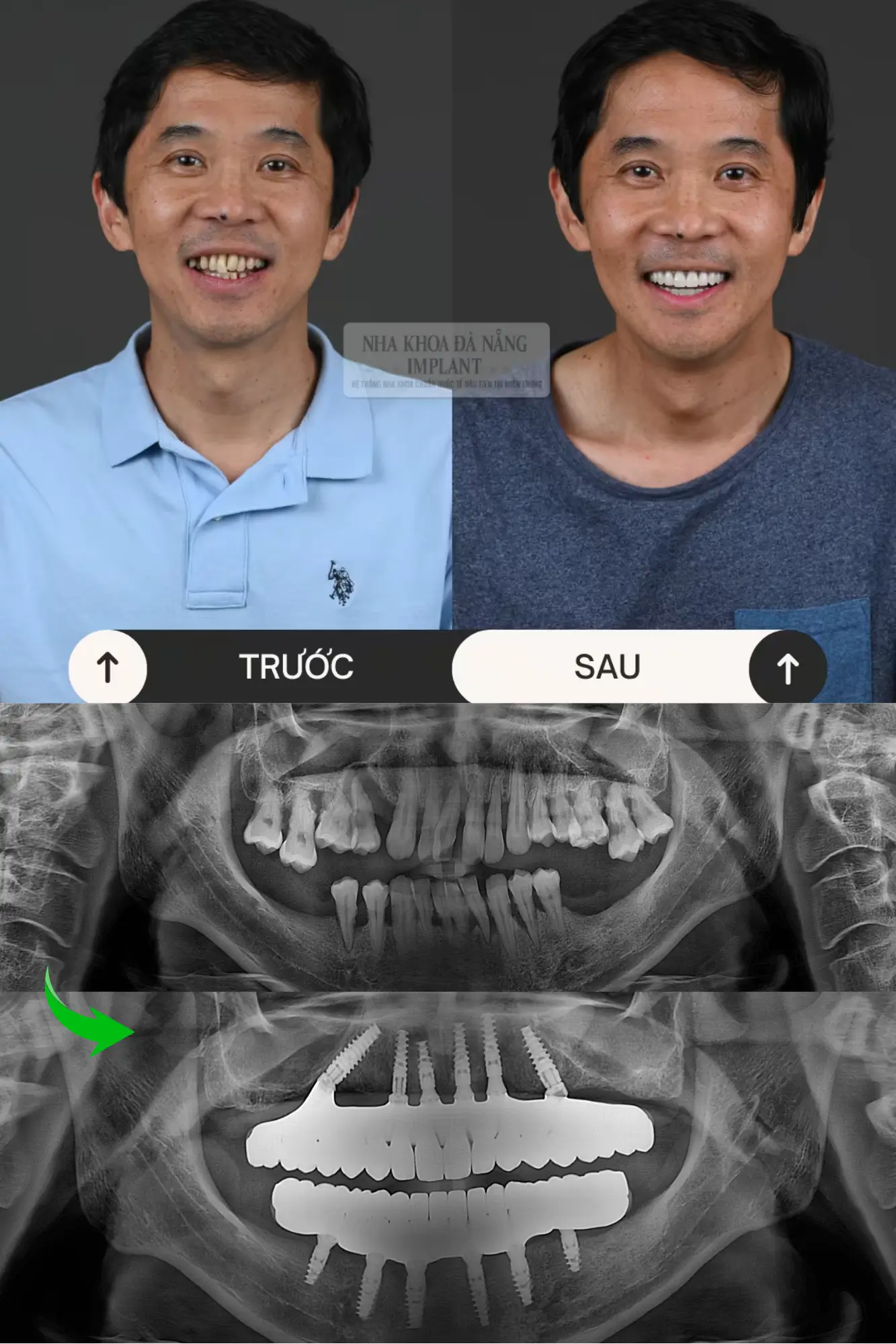 5 Đặc tính của dòng trụ Implant Nobel Biocare - Giải pháp phục hình răng được đông đảo khách hàng lựa chọn 20 Khách hàng Lê Hùng Việt