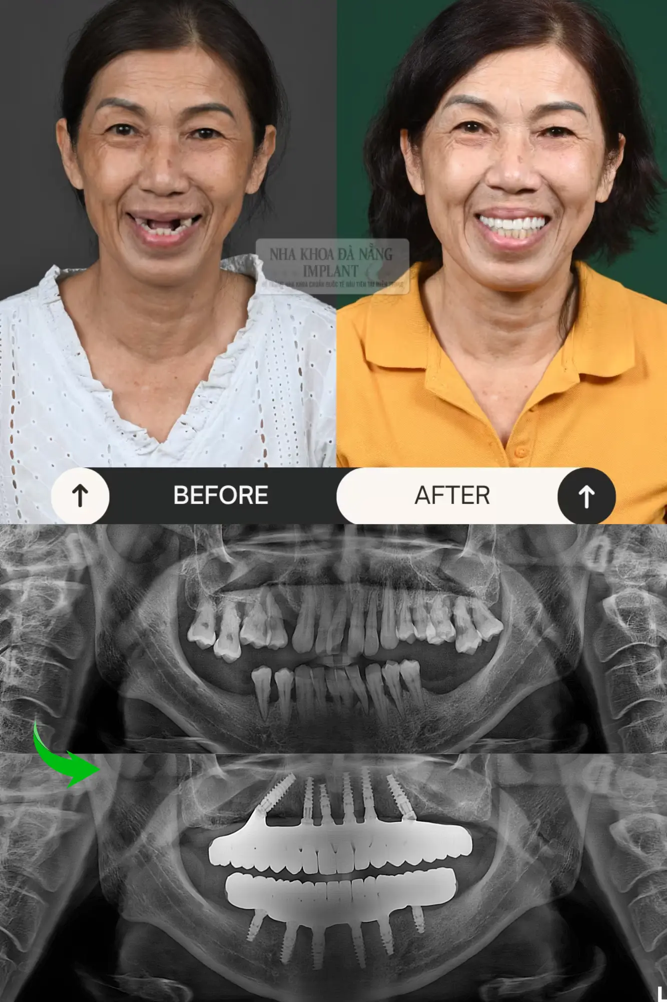 5 Characteristics of Nobel Biocare Implant – A tooth restoration solution widely chosen by customers 19 Patient Le Thi Tinh