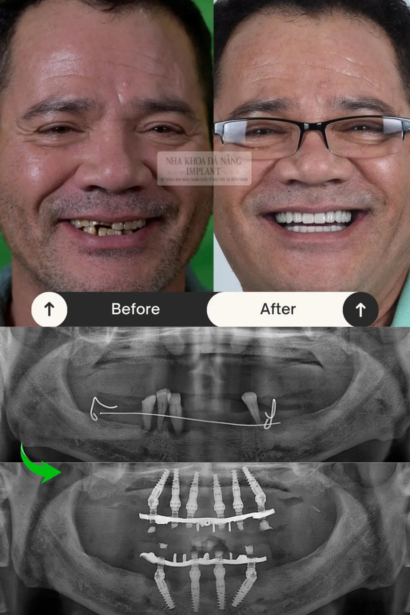 5 Characteristics of Nobel Biocare Implant – A tooth restoration solution widely chosen by customers 18 Patient Duong Binh