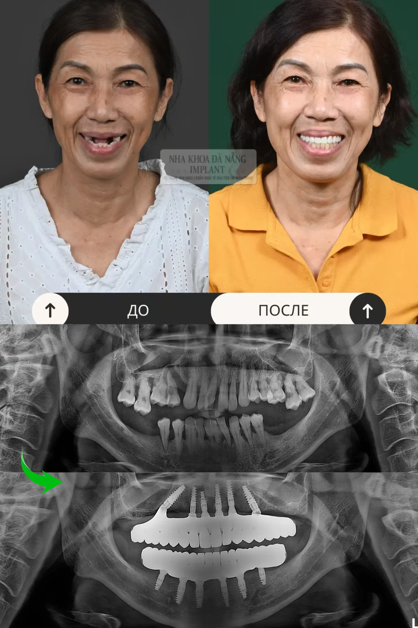 5 Характеристик имплантов Nobel Biocare – Решение для восстановления зубов которое выбирают многие клиенты 19 Пациент Le Thi Tinh