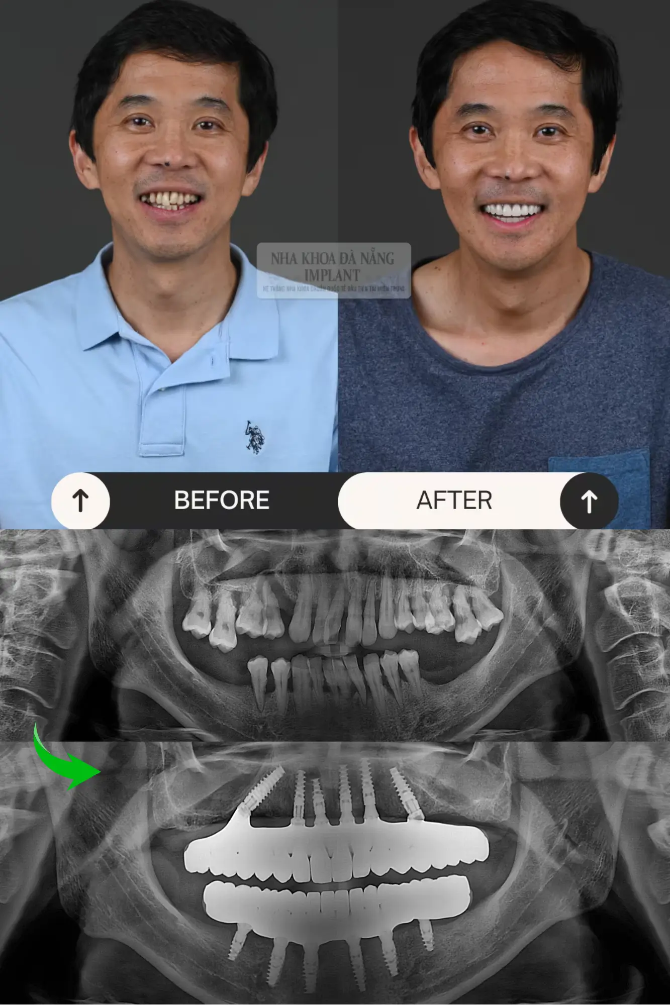 5 Characteristics of Nobel Biocare Implant – A tooth restoration solution widely chosen by customers 20 Patient Le Hung Viet